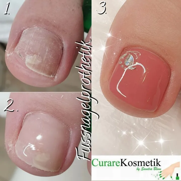 Fussnagelprothetik in drei Schritten
