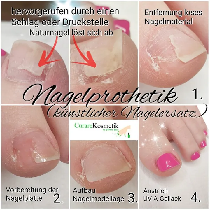 Nagelprothetik am Fuss in vier Schritten, von der Vorbereitung bis zum Anstrich mit Gellack