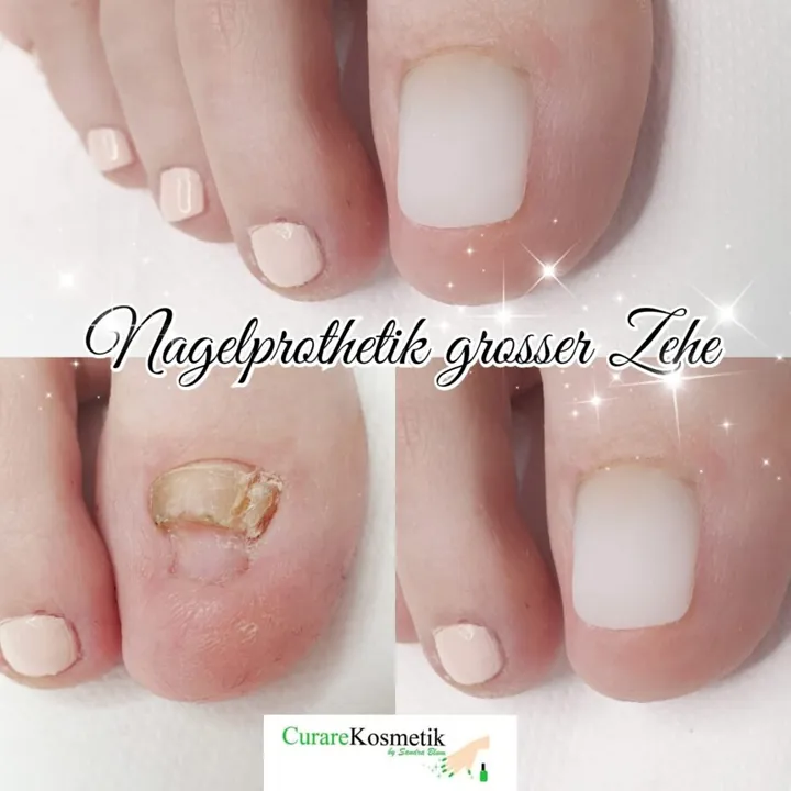 Nagelprothetik an der grossen Zehe